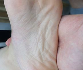 한포진 치료 후