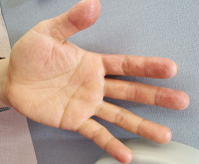49세 남성 · 12개월 경과