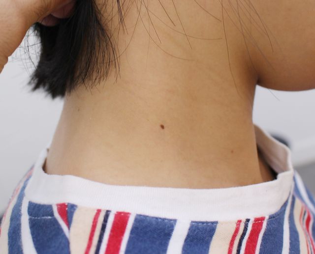 30세 여성 · 3개월 경과