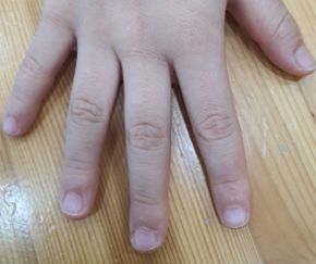 사마귀 치료 후